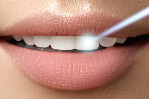 Bright Smile of Wesley Chapel Woman After Getting Laser Dentistry Services