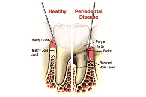 Healthy Tooth Vs One That Needs Managing Gum and Periodontal Disease in Wesley Chapel FL