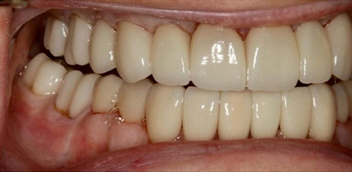 Teeth of Wesley Chapel Man After Going To Dental Clinic with Modern Technology and Techniques
