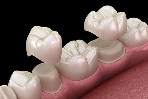 Demo of How Porcelain Crowns Are Put on the Teeth by Wesley Chapel Dentist
