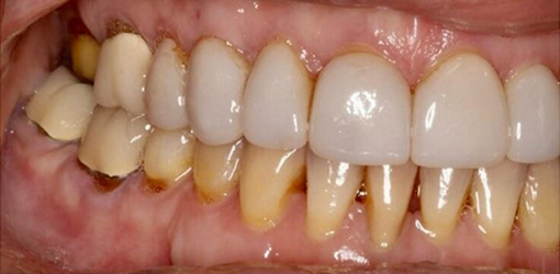 Teeth of a Man From Wesley Chapel FL Before Getting Porcelain Crowns