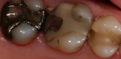 Silver Crown of Wesley Chapel Man To Be Replaced by Porcelain Crowns