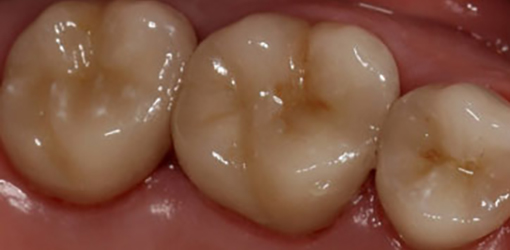 New Porcelain Crowns Installed by Top Dentist in Wesley Chapel FL