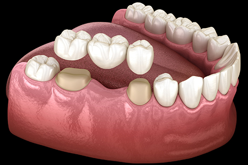Dental Bridge and Crown As Part of Reconstructive Dentistry in Wesley Chapel Florida