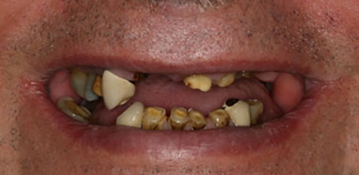 Teeth of Wesley Chapel Man Before Visiting Dentist Experienced in Reconstructive Dentistry