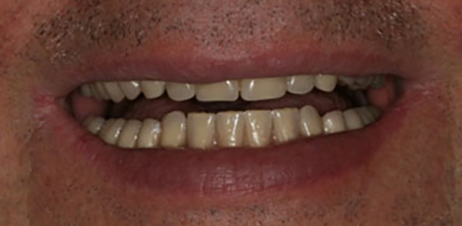 Image of Wesley Chapel Man's Teeth After Visiting Dentist Experienced in Reconstructive Dentistry