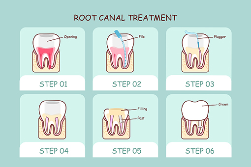 Steps For Restorative Dentistry Root Canal Treatment in Wesley Chapel Florida