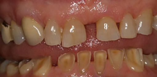 Image of Teeth of Wesley Chapel Patient Before Visiting Restorative Dentistry Clinic