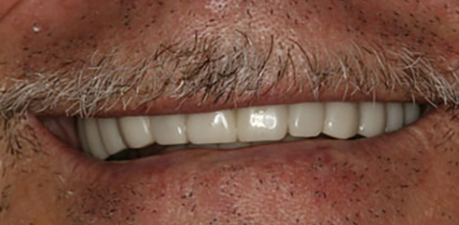 Fixed Teeth of Wesley Chapel Resident After Getting Restorative Dentistry Services