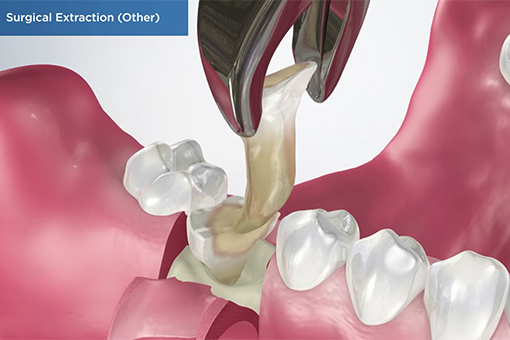 Demo of How Surgical Tooth Extraction Is Done at a Wesley Chapel Dental Clinic