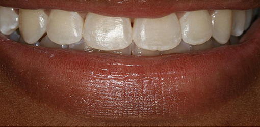 Teeth of Wesley Chapel Man Before Getting Zoom Teeth Whitening Services