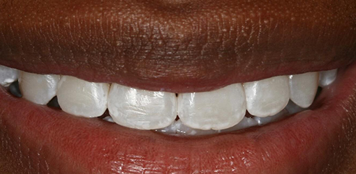 Wesley Chapel Man's Teeth After One Session of Zoom Teeth Whitening