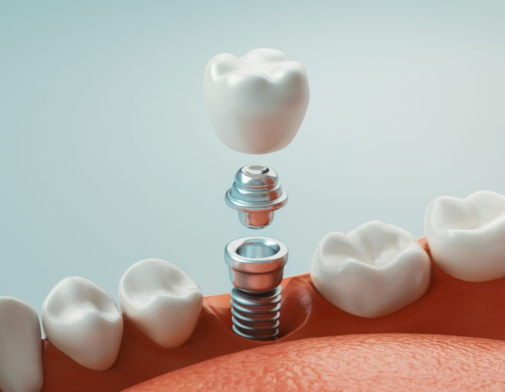 dental implants near me